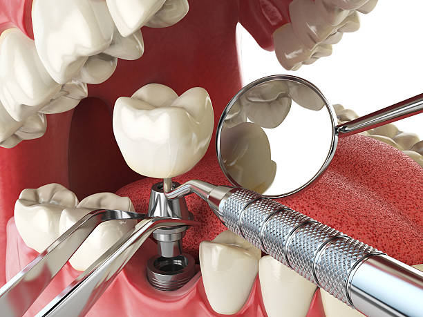 Best Emergency Wisdom Teeth Removal in Phillips, WI